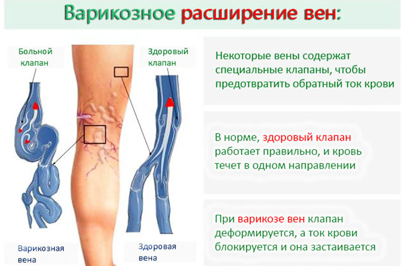 Варикозное расширение вен малого таза