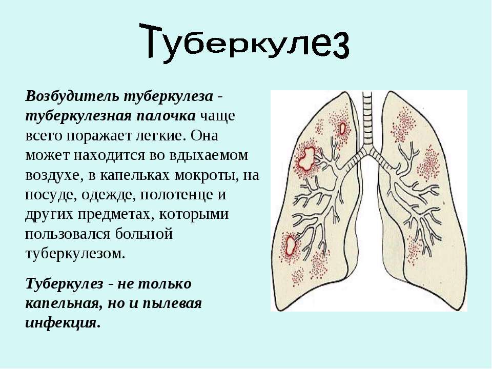 туберкул