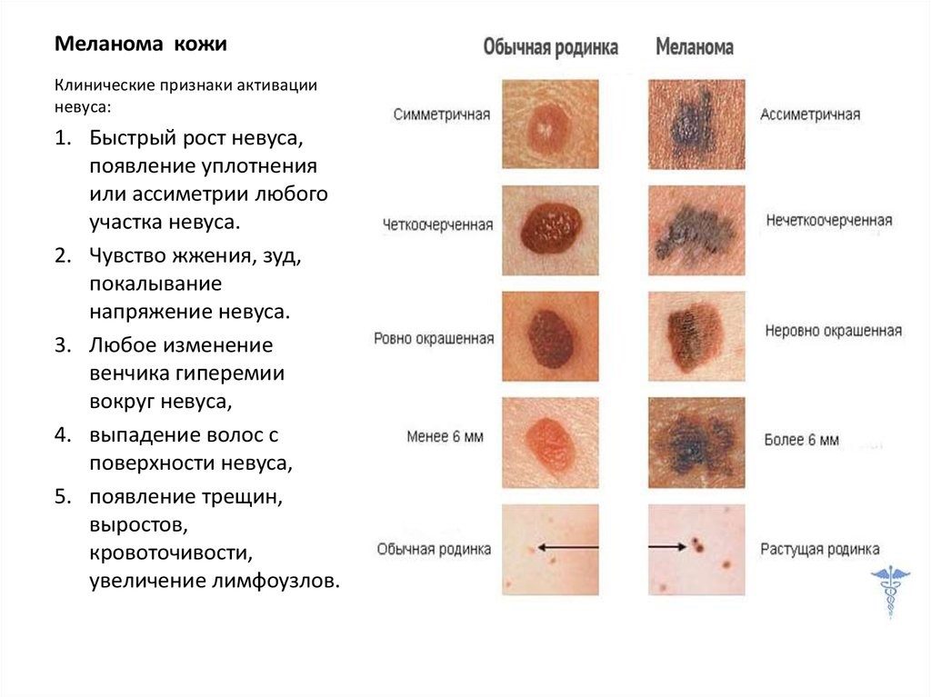 melanoma i rak2