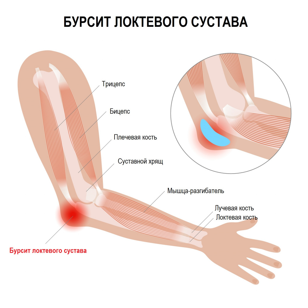 Бурсит локтевого сустава - Быть здоровым - это элементарно - УЗ 